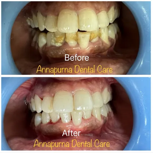 Laser Scaling Case 24